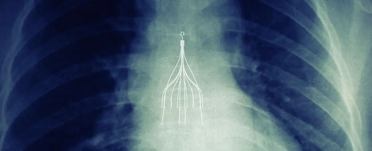Chest x-ray showing an IVC filter implanted in the inferior vena cava